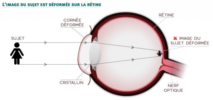 astigmatie